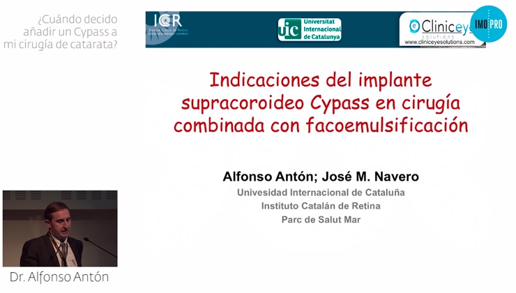 When should I decide to add a Cypass to my cataract surgery?  Alfonso Antón
