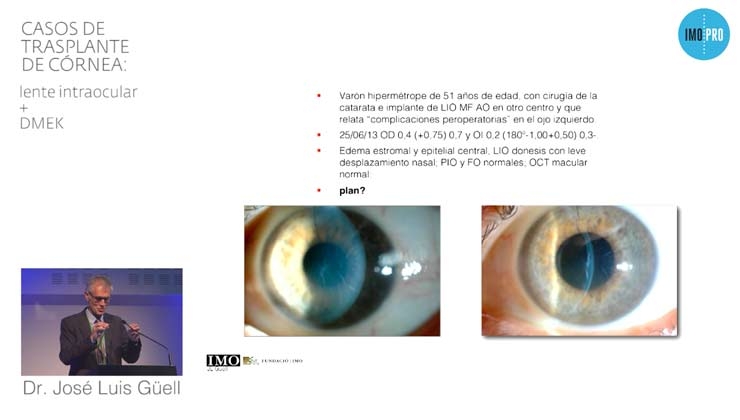 Casos de trasplante de córnea: lente intraocular + DMEK