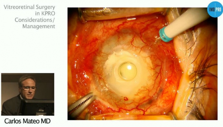 Vitreoretinal Surgery in KPRO Considerations / Management