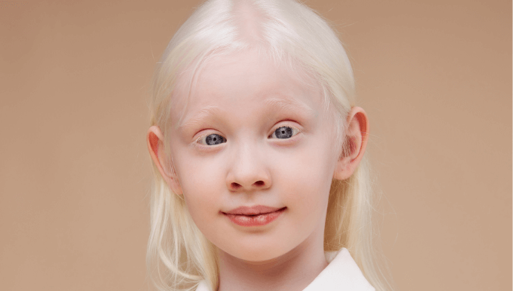 El origen del albinismo