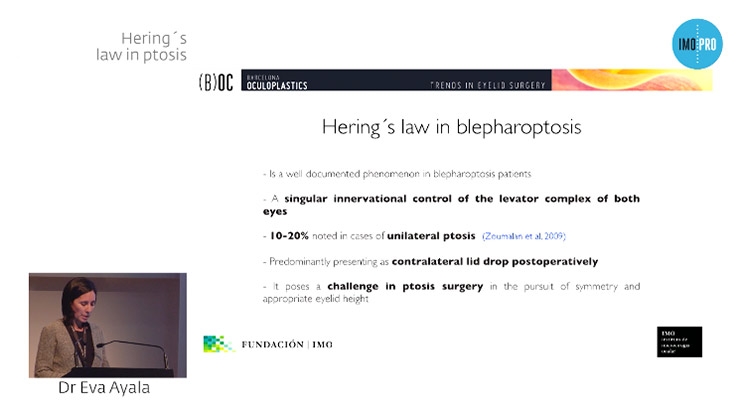 Hering’s law in ptosis