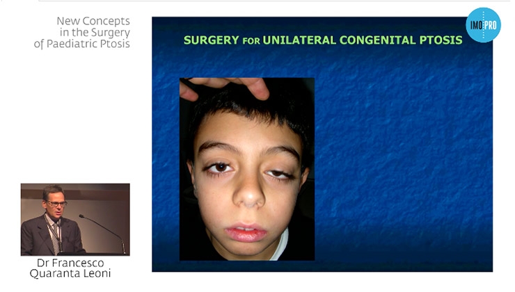 New concepts in the surgery of paediatric ptosis
