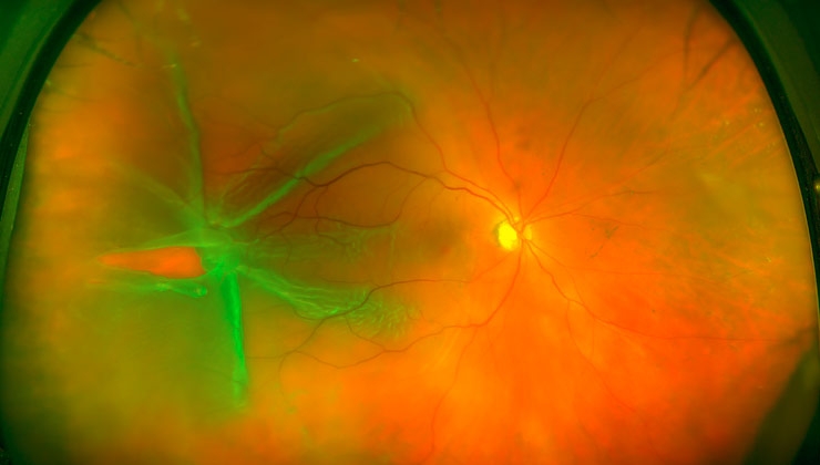 Máster en vítreo-retina