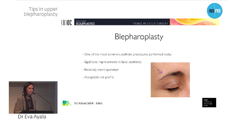 Tips in upper blepharoplasty