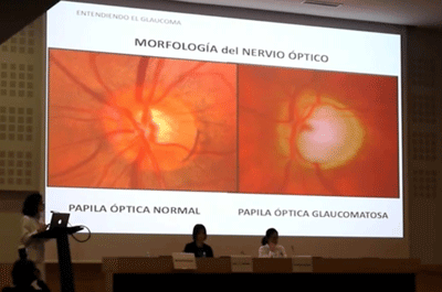 Conferencia sobre Glaucoma para profesionales