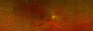 Retina post laser